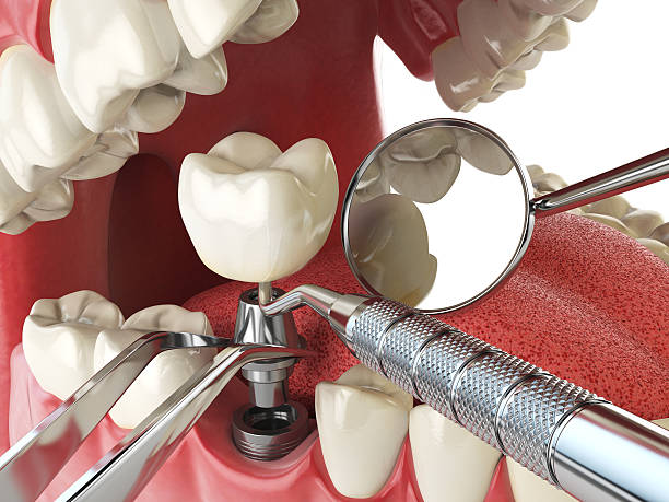 Best Lost Filling or Crown Replacement in Pasadena, MD