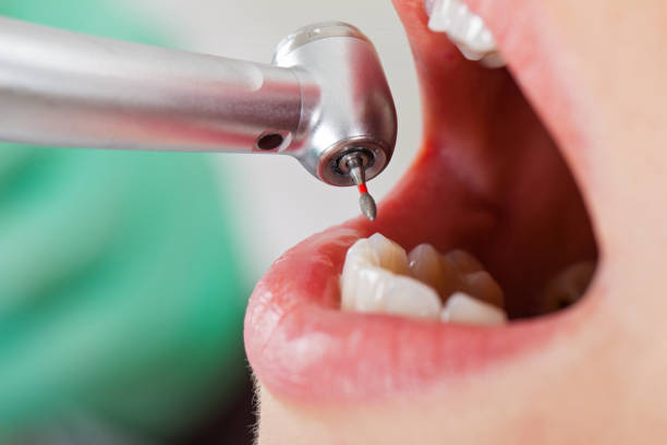 Best Dental Abscess Treatment in Pasadena, MD